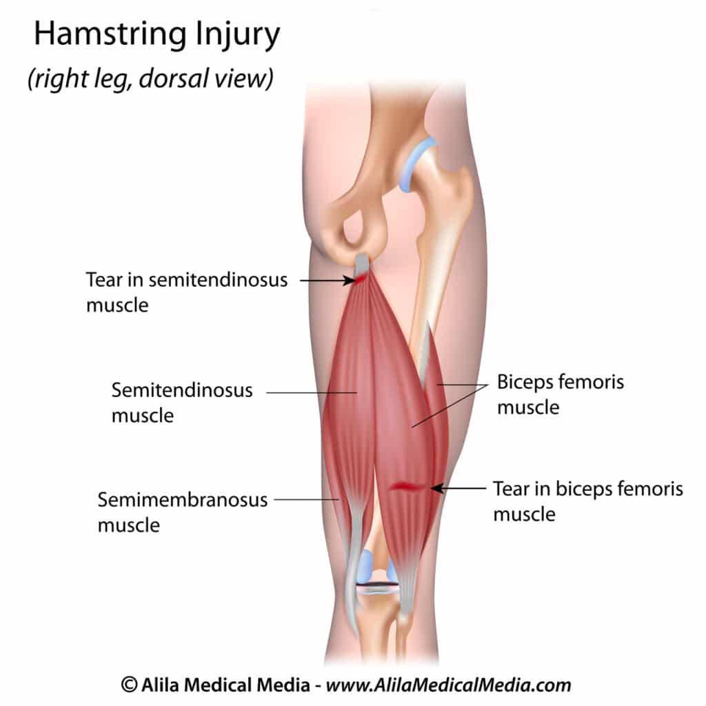 Prox Insertional Hamstring Proximal Hamstring Tendon Repair: Tear & Recovery