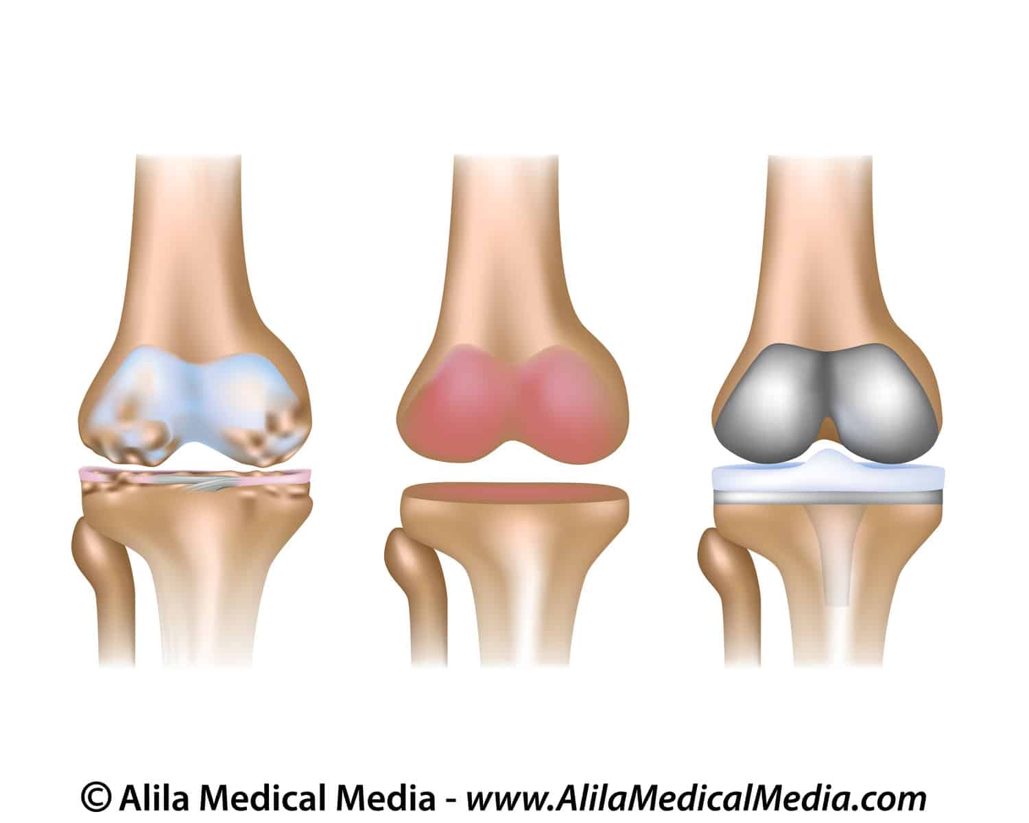 3.A. knee replacement unlabeled