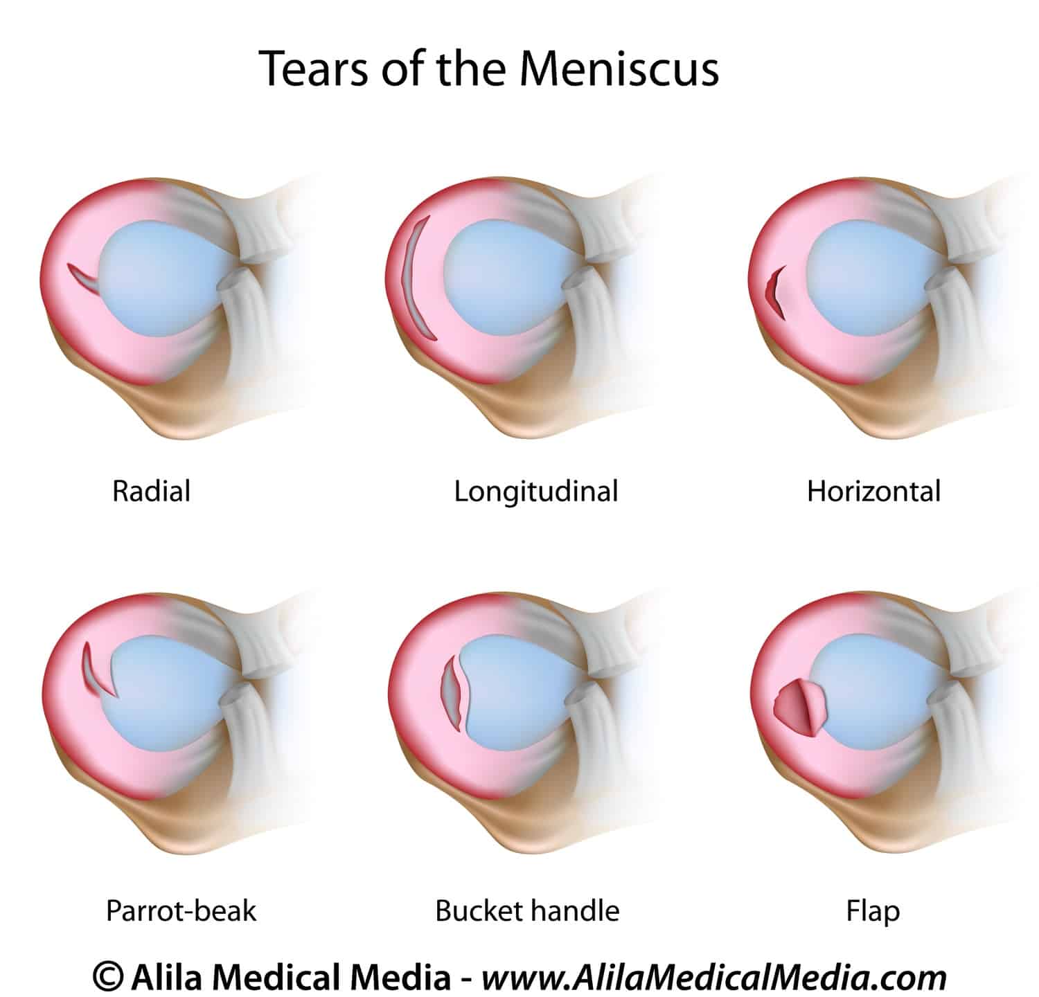 Types of Meniscus tears