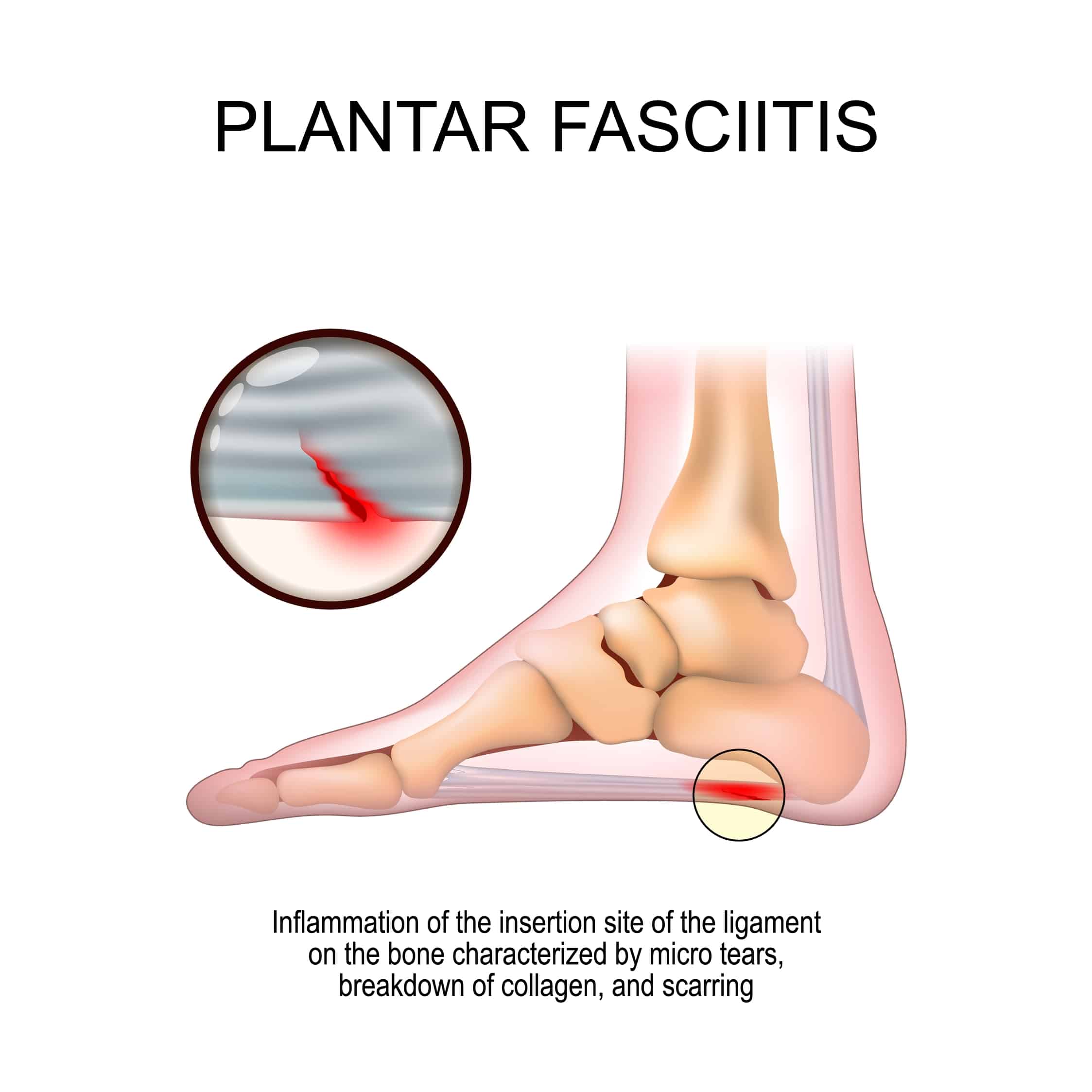 Plantar,Fasciitis.,Foot,With,The,Symptoms,Of,Plantar,Fasciitis.,Disorder