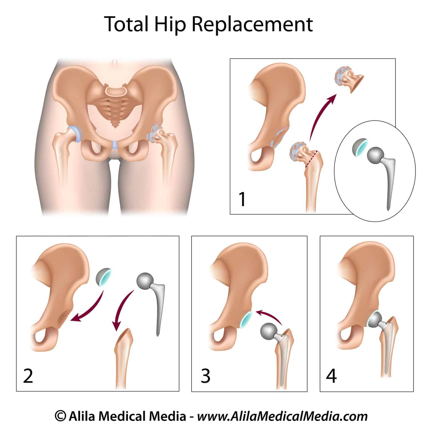B.A. Anterior hip replacement